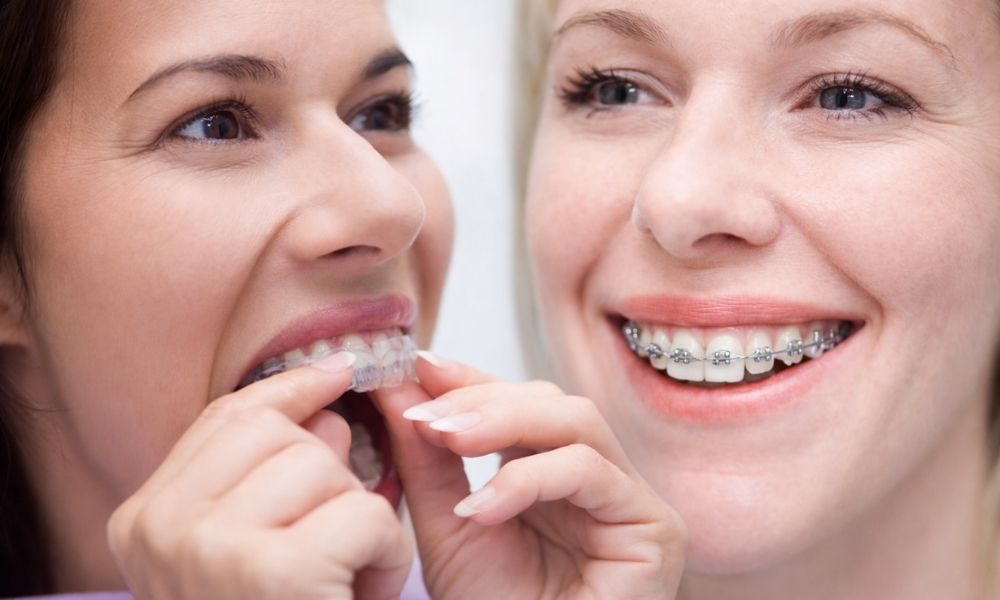 Clear Aligners vs Traditional Braces