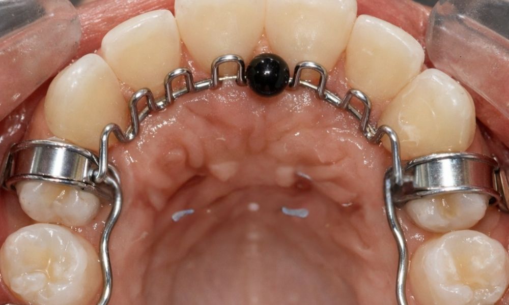 real purpose of a palatal crib