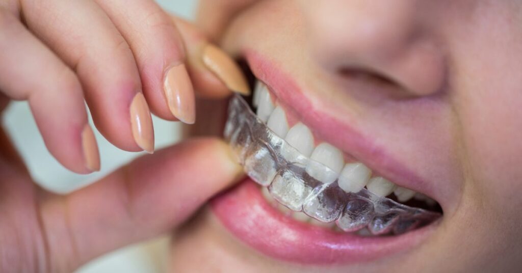 Clear Aligners Treatment