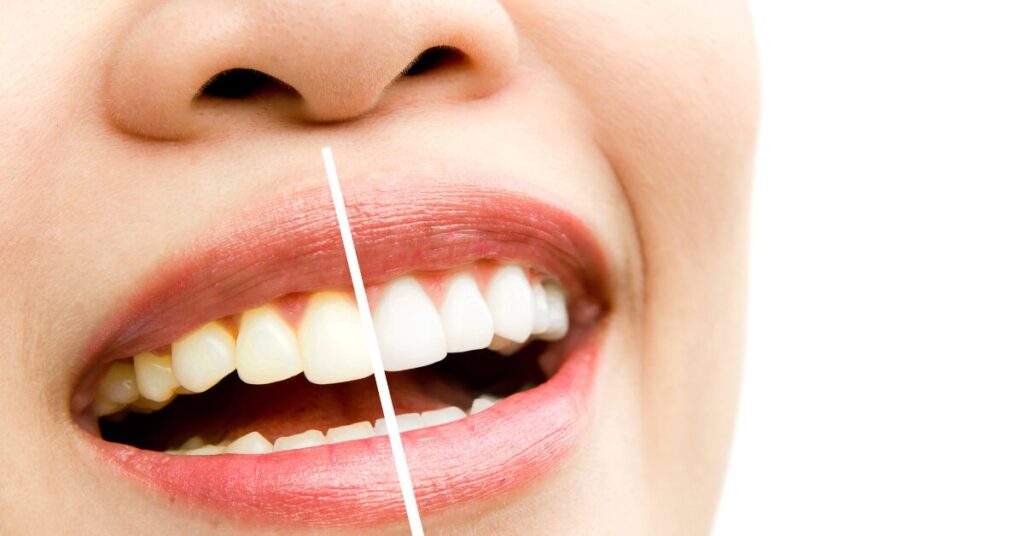 Cosmetic Dentistry in Chennai