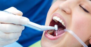 Dental Fillings