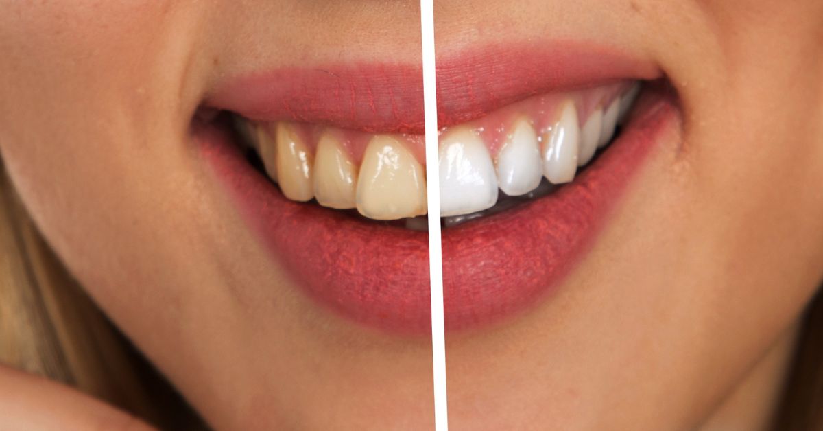 What Is Teeth Whitening and How Much Does It Cost in Chennai?